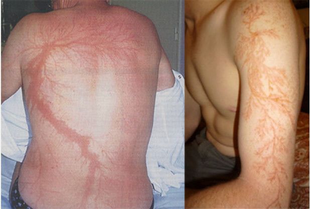 Scars Caused by Lightning